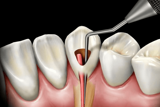 Endodontia tem a finalidade de tratar e restaurar internamente os dentes - Recupere a funcionalidade.