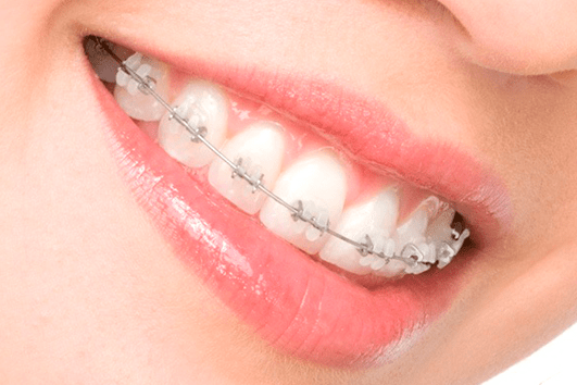Ortodontia tem a função de alinhar de forma ideal os dentes e pode ser aplicada em crianças e adultos. - Recupere a funcionalidade.