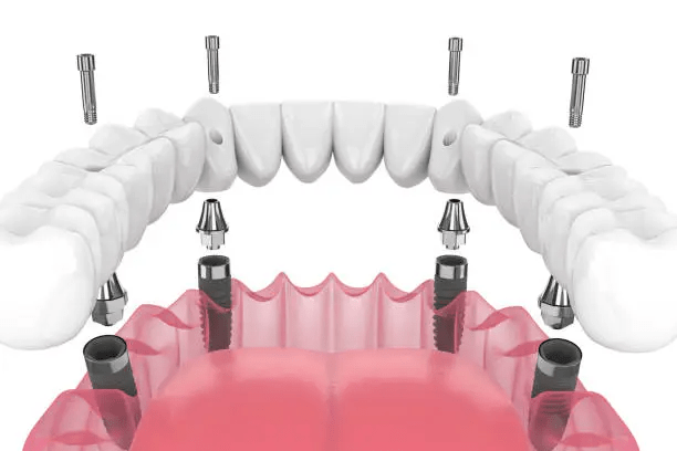 Implantes Dentários 002