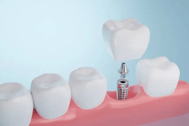 Implantes Dentários 003