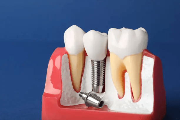 Implantes Dentários 001