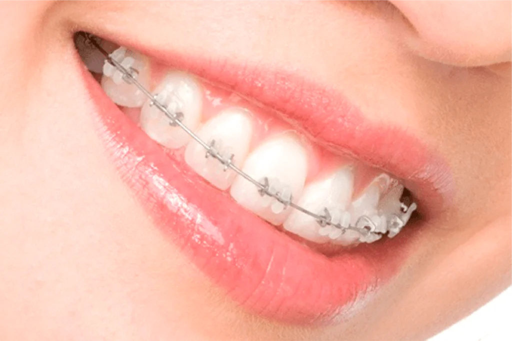Sorriso com aparelho ortodôntico estético de bráquetes transparentes e arco metálico.
