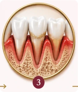 Periodontite com comprometimento dos tecidos de suporte dos dentes