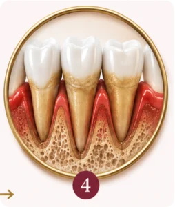 Periodontite avançada com perda dos tecidos de suporte dentário