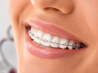 Sorriso com aparelho ortodôntico na Rodrighero Odontologia em Perdizes