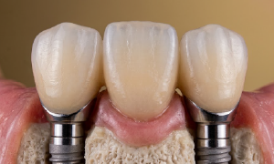 Prótese fixa em porcelana composta por três dentes integrados sustentados por dois implantes dentários de titânio fixados no osso.
