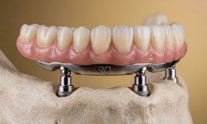 Prótese protocolo para arcada total fixada sobre quatro implantes dentários no osso mandíbula, demonstrando reabilitação oral completa.