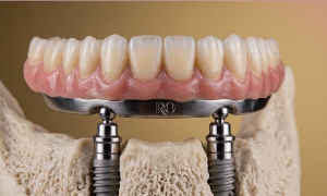 Sobredentadura removível de arcada total para mandíbula, demonstrando o sistema de encaixe sobre dois implantes dentários de titânio fixados no osso.