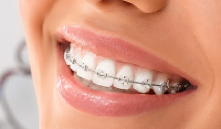 Sorriso com aparelho ortodôntico na Rodrighero Odontologia em Perdizes